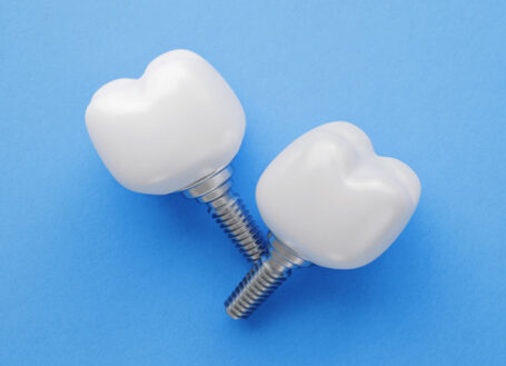 IMPLANTS – The answer to replacing missing teeth