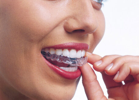 STRAIGHTENING YOUR TEETH WITH INVISIBLE ALIGNERS
